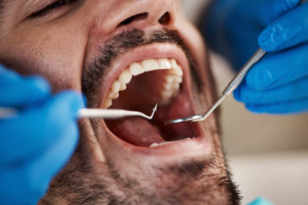 Best Knocked-Out Tooth Emergency  in Pinewood, FL